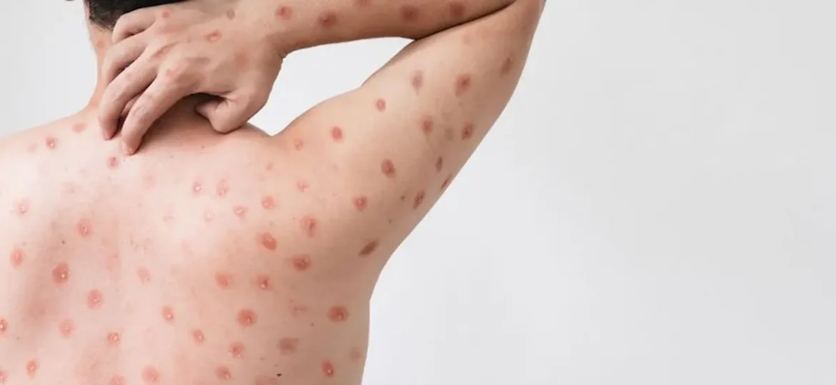 Lesões cutâneas características da Mpox em paciente adulto durante surto recente no Brasil.