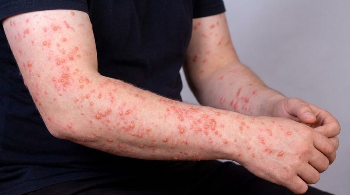 Braços de pessoa exibindo diversas lesões avermelhadas e bolhas associadas à mpox