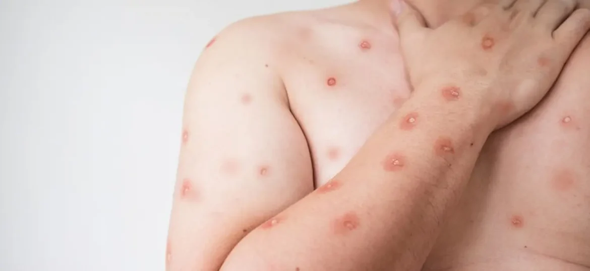 Lesões típicas da mpox espalhadas pelo braço e região do peito de uma pessoa infectada.