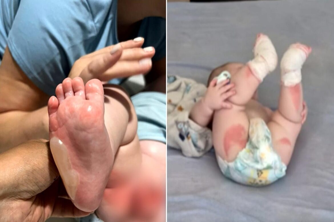 Pés de bebê com queimaduras e bolhas à esquerda; bebê deitado com curativos nas pernas e pés à direita