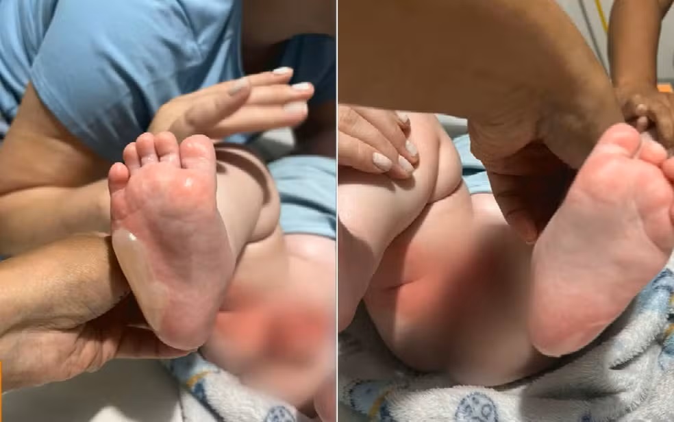 Bebê sofre queimaduras de segundo grau em 29% do corpo durante banho em berçário de Rio Verde 2 Pés de bebê com vermelhidão intensa e bolhas causadas por queimaduras de segundo grau em berçário de Rio Verde