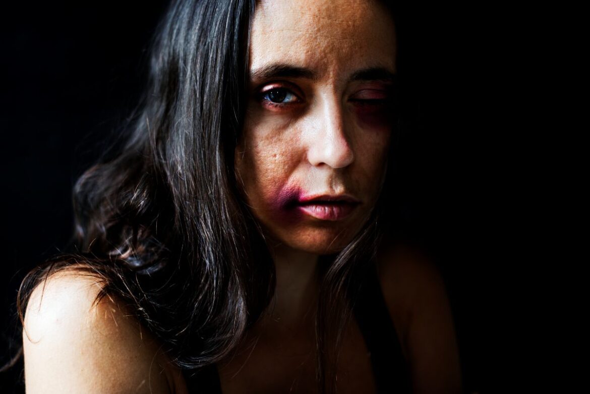 Close de uma mulher com olhos e lábios com hematomas roxos, cabelos pretos sobre o rosto e um fundo preto.