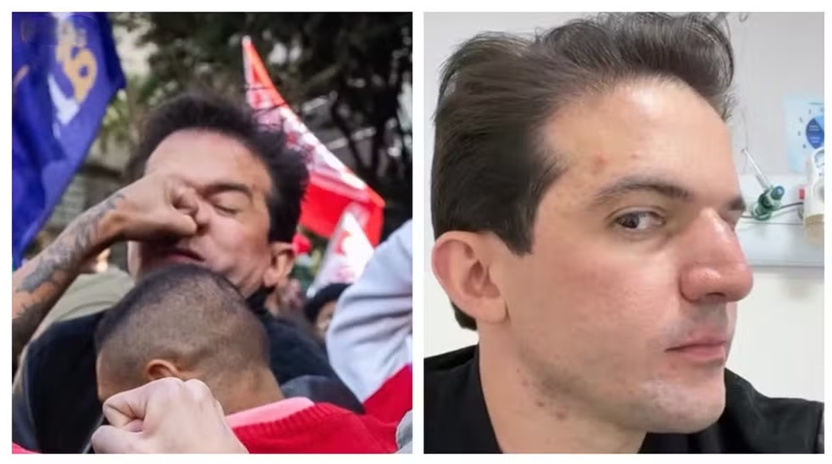 Vereador que recebeu soco em protesto de estudantes diz que fraturou o nariz 6 Vereador Rubinho Nunes levando soco no rosto durante protesto de estudantes e depois no hospital com nariz inchado