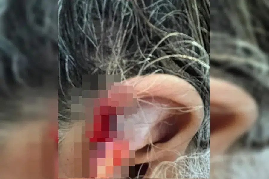 Caso chocante: neto morde e engole parte da orelha da avó em agressão 6 Orelha de idosa de 73 anos com ferimento grave e área pixelada após ataque do neto em Anápolis